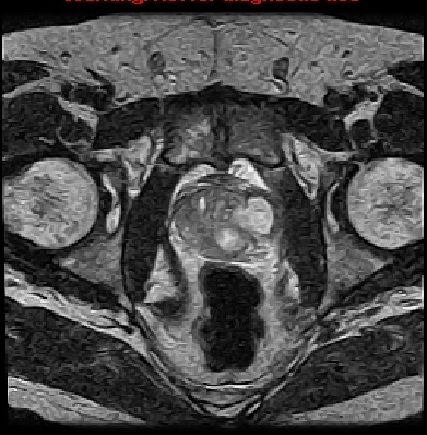 prostatic abscess radiology)
