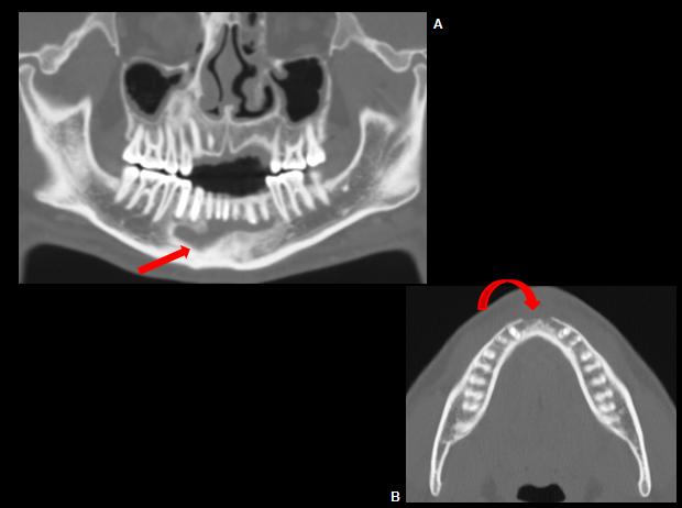 osteomyelitis x ray jaw