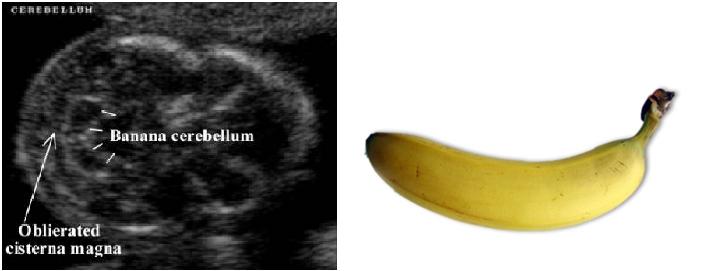 Banana sign (cerebellum), Radiology Reference Article