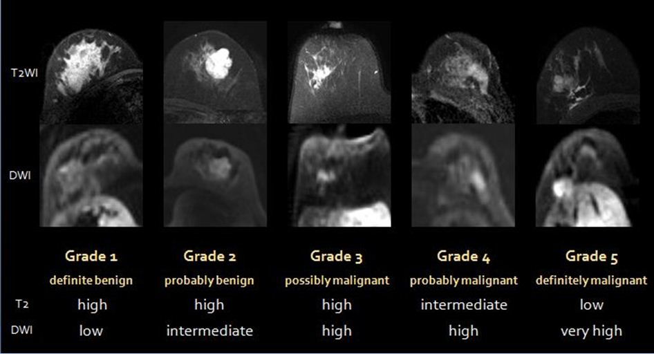 Comparison of SI with b value of 1000 s/mm2 in malignant and benign