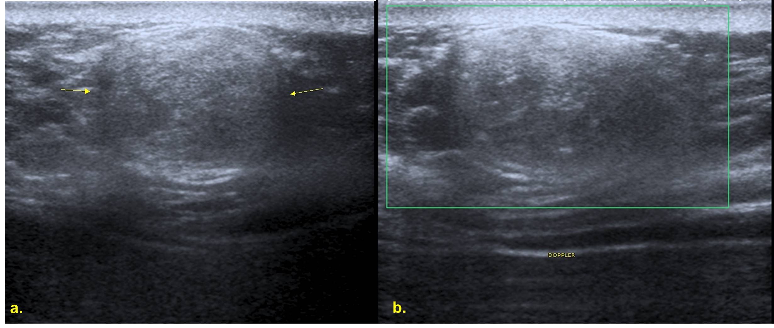 echogenicity-of-thyroid-cancer-arrow-a-isoechoic-nodule-on-the