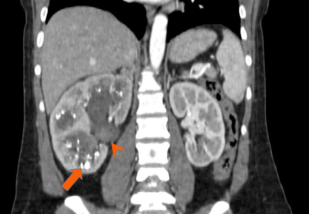 medullary sponge kidney