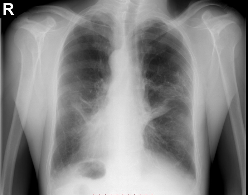 Chest X-Ray breakdown: a guide to bronchiectasis on imaging - YouTube