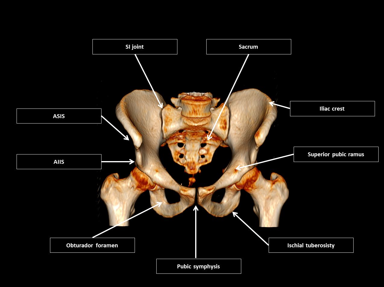 Pelvic insufficiency fractures | Radiology Reference Article |  Radiopaedia.org