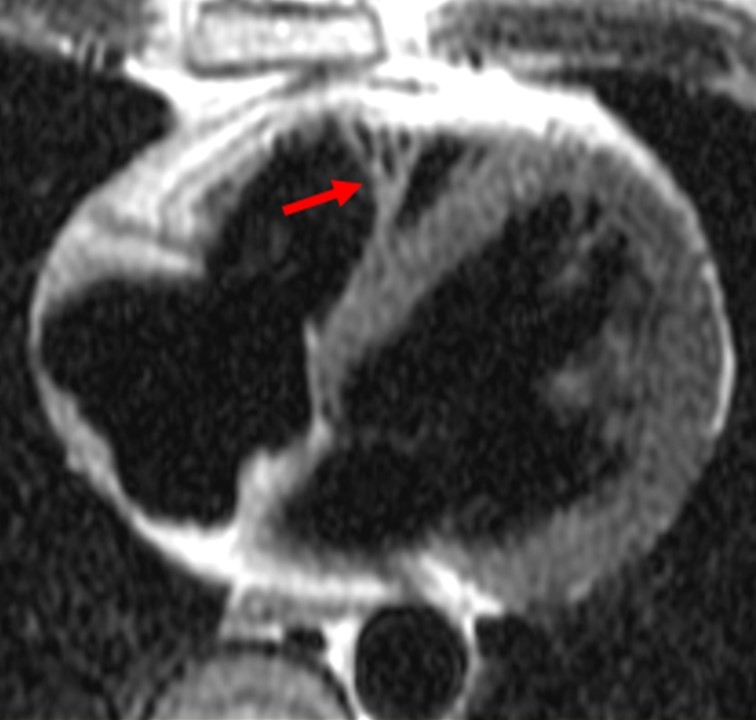 Normal ventricular variants. a Moderator band (arrow) and an