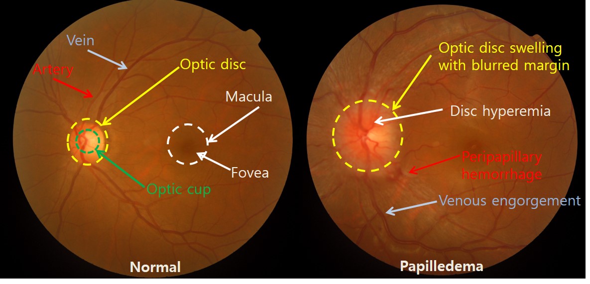 papilledema vs glaucoma