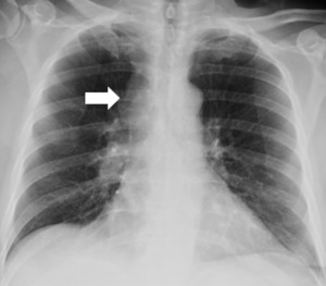 theRadiologist on X: ANATOMY: Chest X-Ray fused with coronal CT showing  mediastinal anatomy  / X