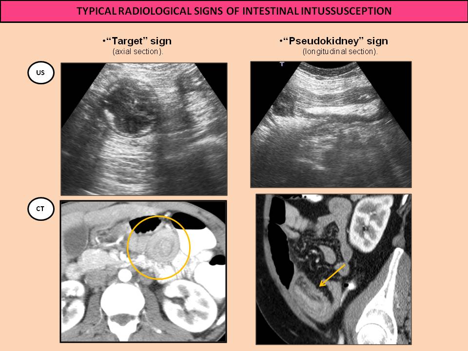 intussusception target sign