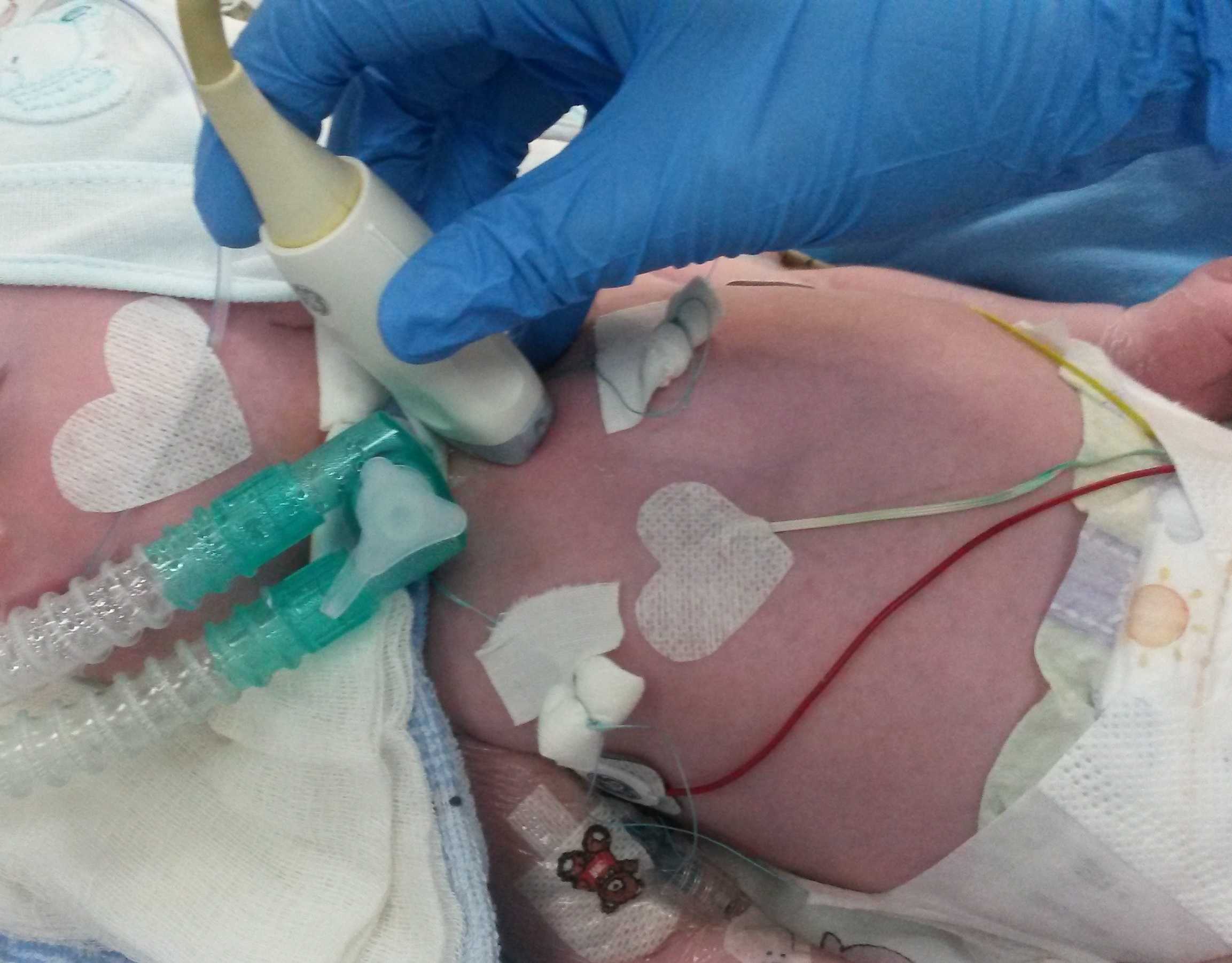 endotracheal intubation in neonates