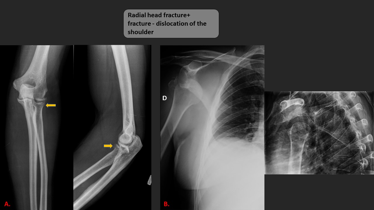 mechanisms of humeral head fracture