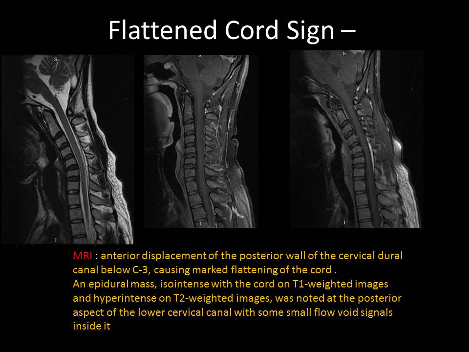 Cervical Spine Realignment and restoring loss of cervical lordosis,  Symptoms and treatments of spinal curvature problems – Caring Medical  Florida
