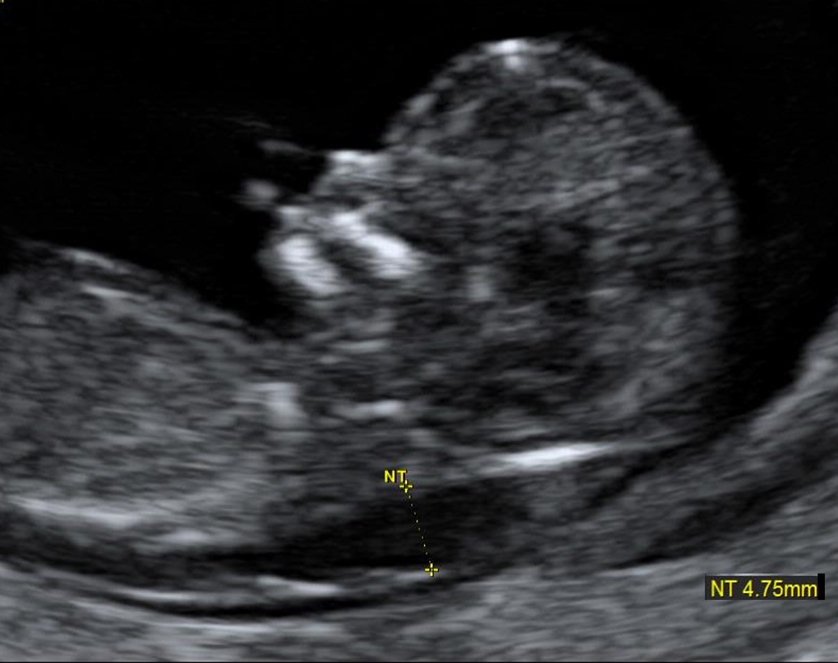 Ultrasound nuchal result translucency Ultrasound