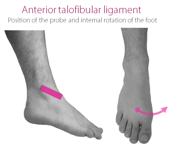 Ankle: Deltoid Ligament Diagram