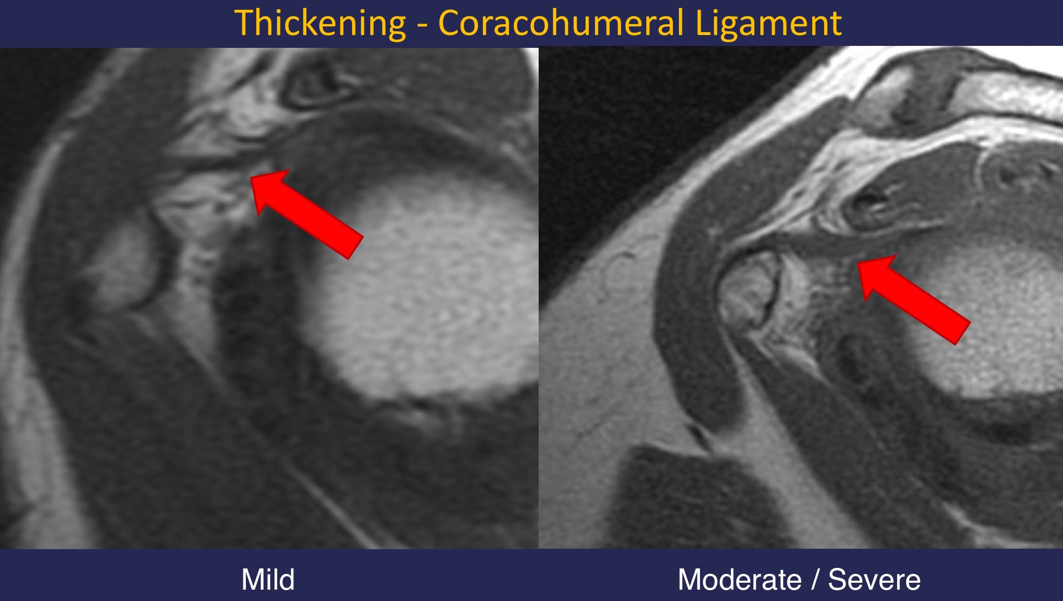 coracohumeral ligament mri