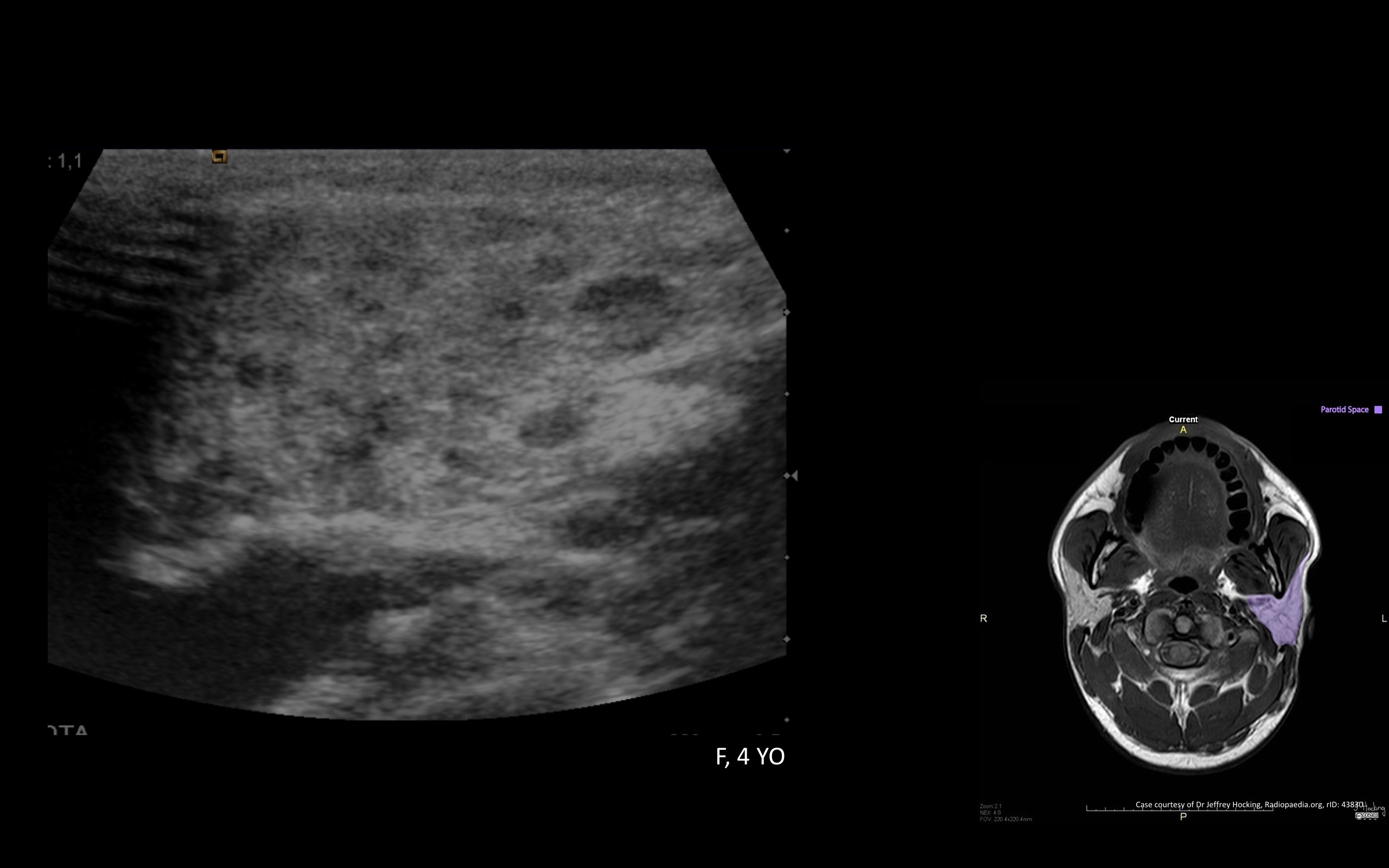parotid gland swelling ultrasound