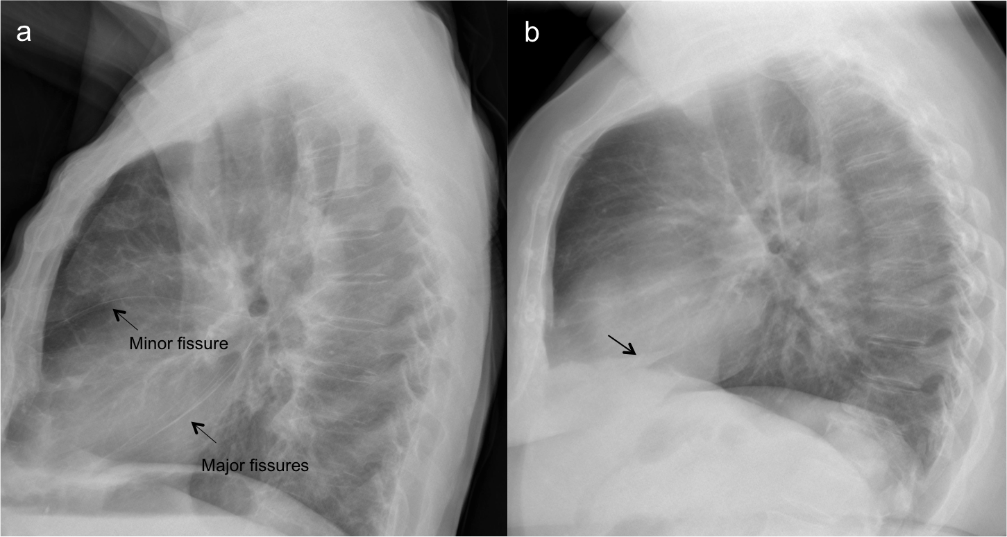 Image: Chest X-Ray of a Patient with Fluid in Minor and Major Fissures -  Merck Manuals Professional Edition