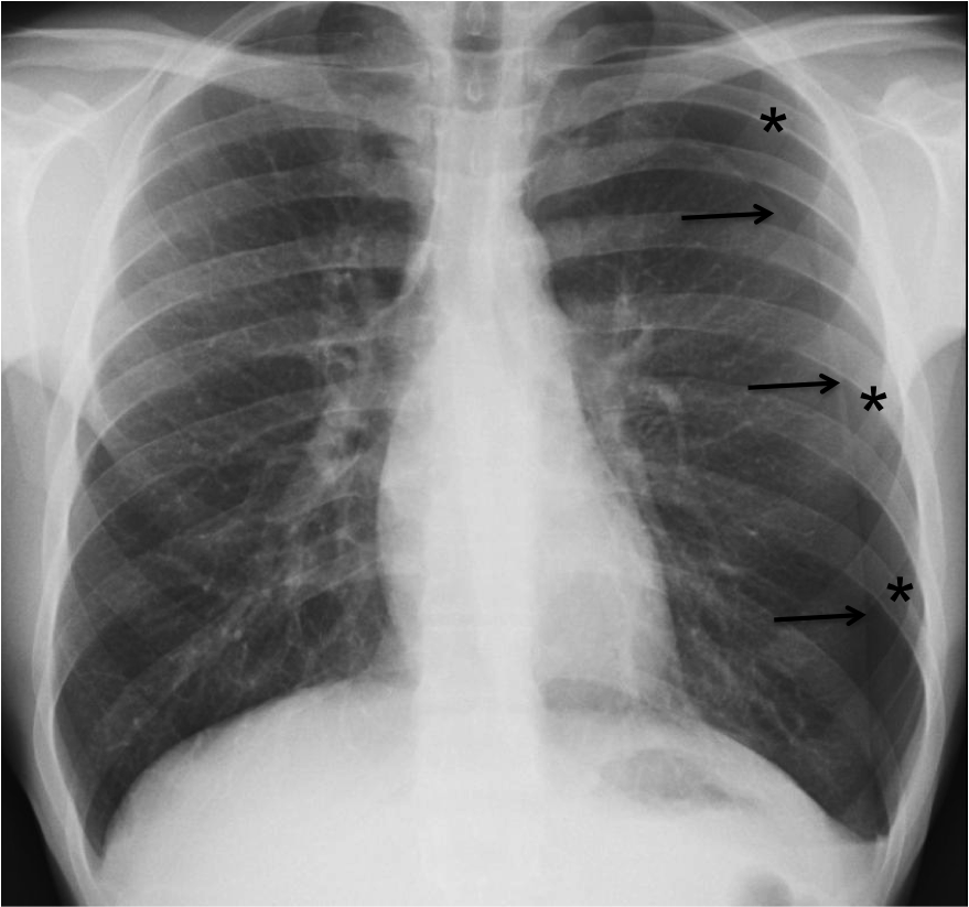 does an x ray show copd