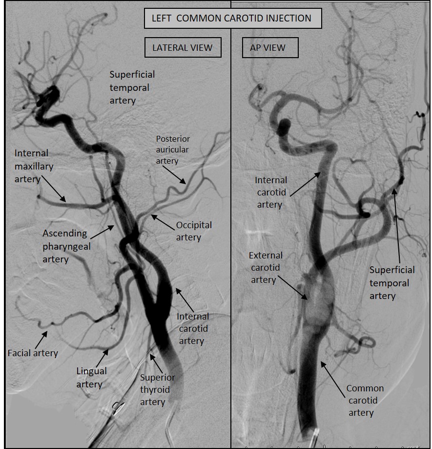 External Carotid Artery Branches Angiogram