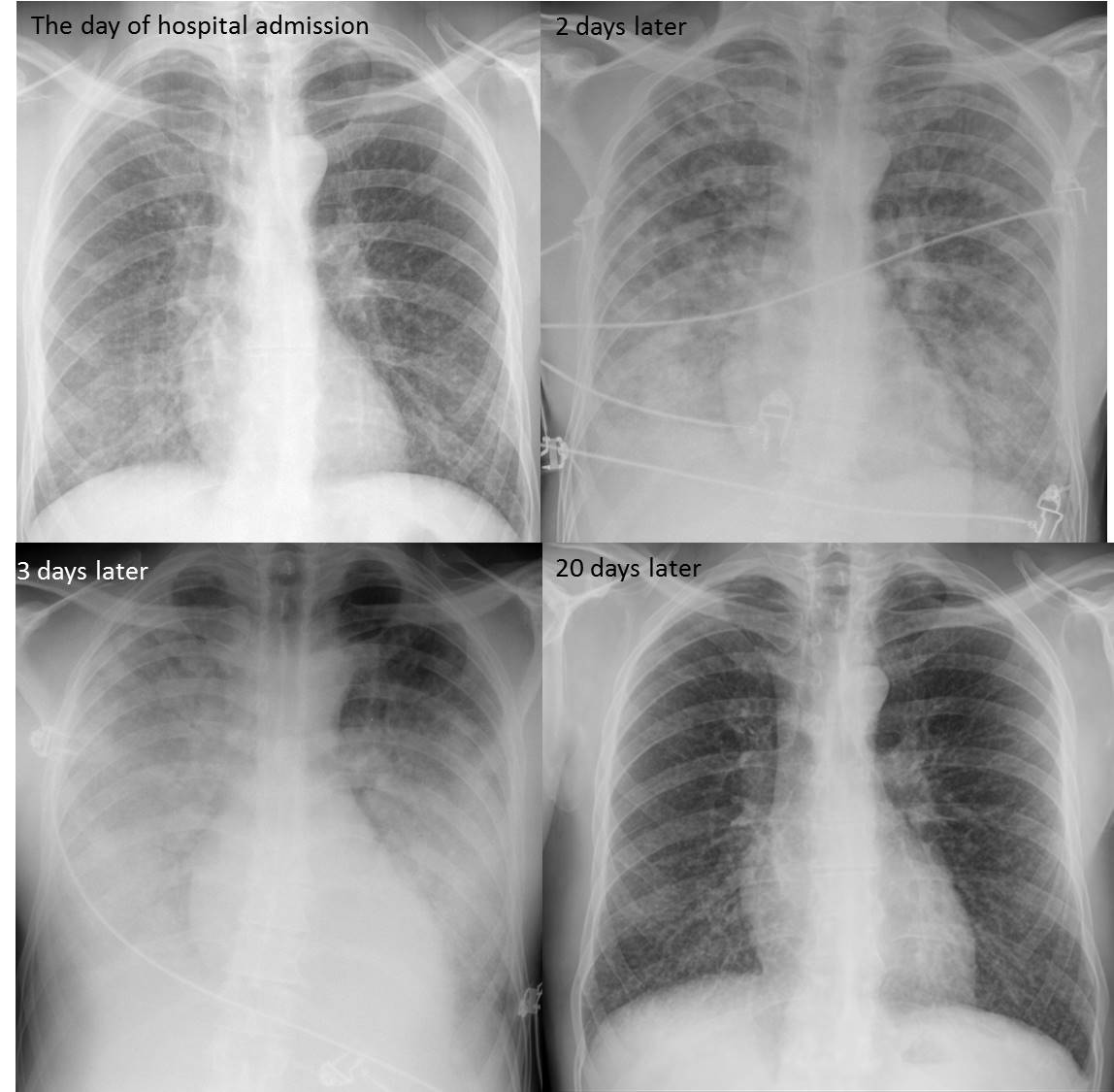 Bilateral bronkopneumonia Pneumonia, Bronkopneumonia