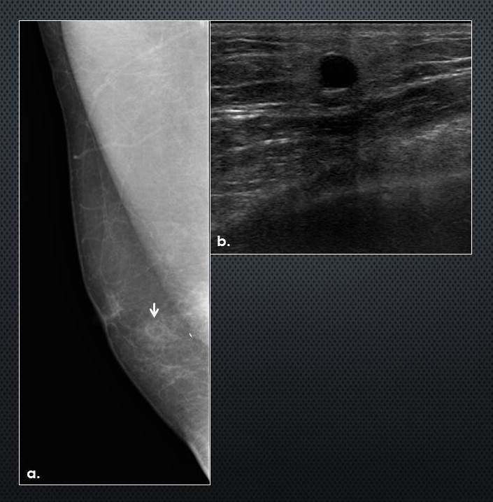 Fat necrosis (breast), Radiology Reference Article