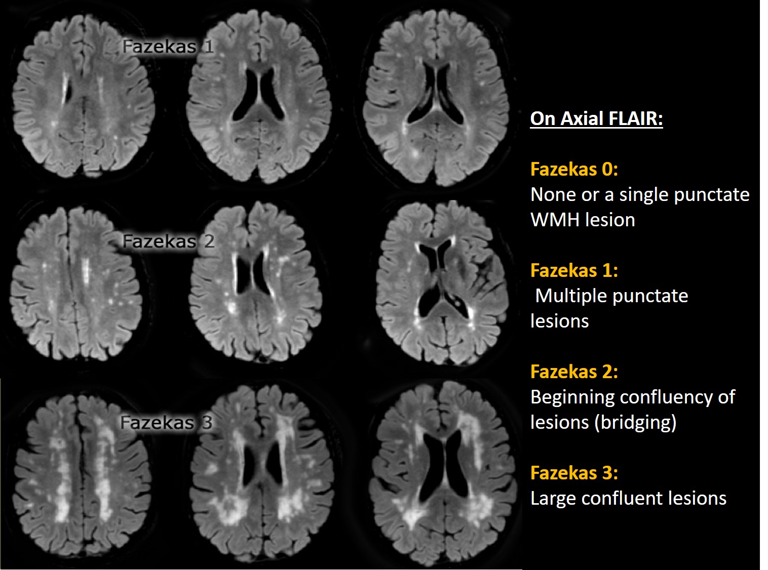 Атрофия головного мозга продолжительность. Лейкоареоз по Фазекас. Лейкоареоз 1 степени по Fazekas что это. Лейкоареоз на кт. Лейкоареоз Fazekas 2.