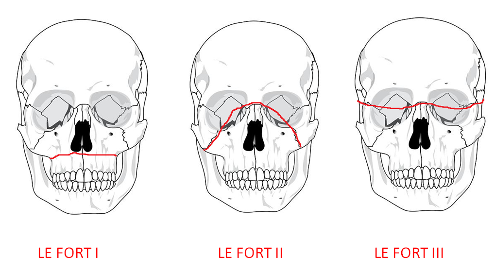 le fort fracture x ray