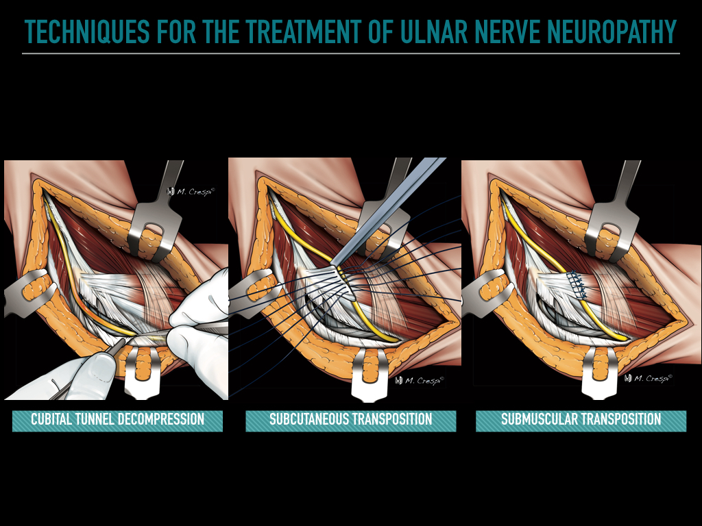 Ulnar nerve release