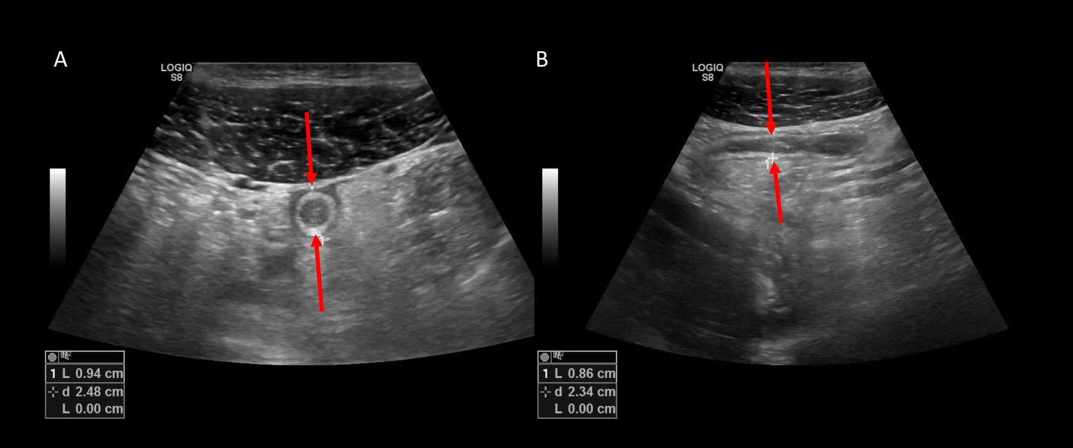 ruptured appendix ultrasound