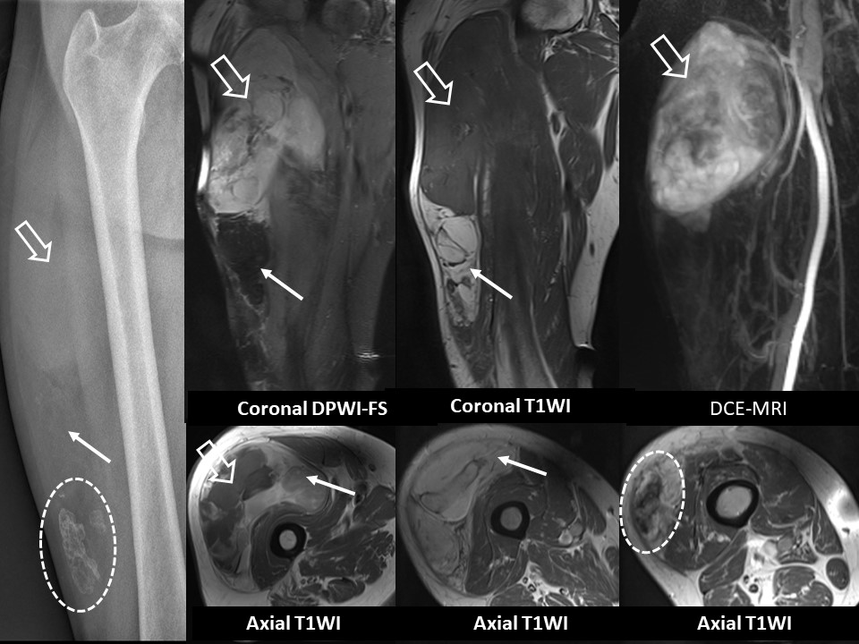 Radiological identification and analysis of soft tissue musculoskeletal  calcifications, Insights into Imaging