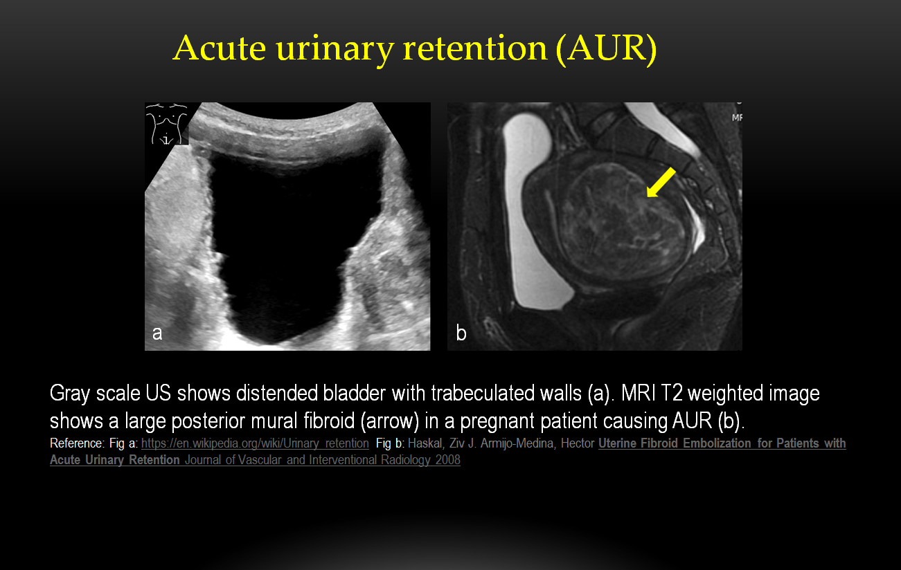 Acute urine retention in early pregnancy resulting from fibroid