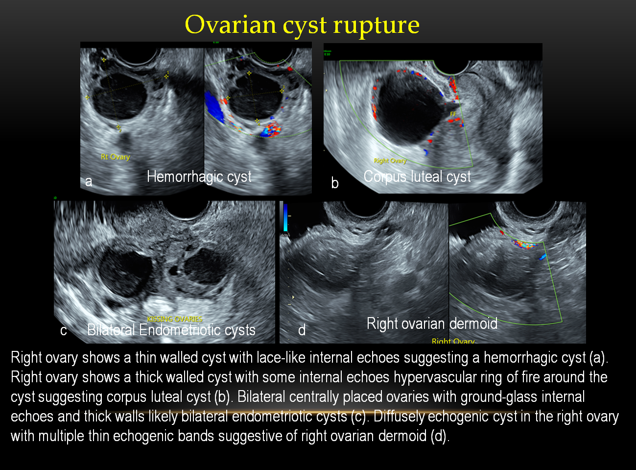 Ruptured ovarian hemorrhagic cyst, Radiology Case