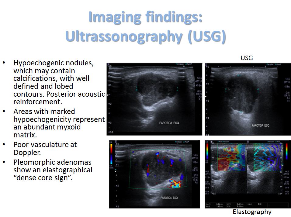 pleomorphic adenoma ultrasound