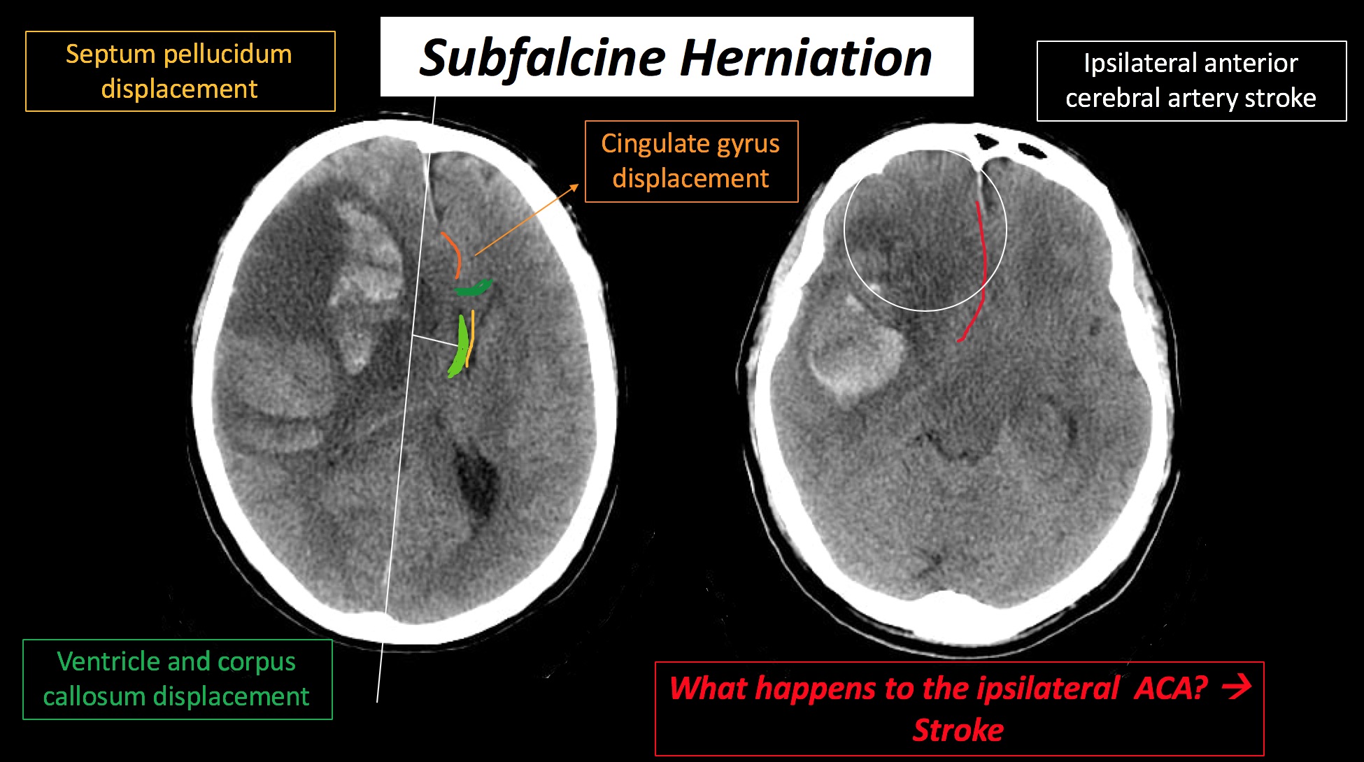 subfalcine herniation