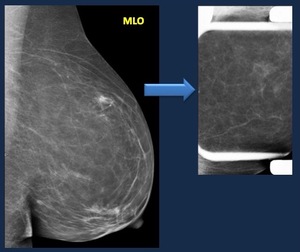 Breast asymmetry: Causes, diagnosis, and mammogram results
