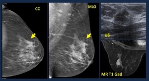 focal asymmetry epos mass yo lobulated mammogram slight hypoechoic causes acoustic screening procedure findings fig solid woman details
