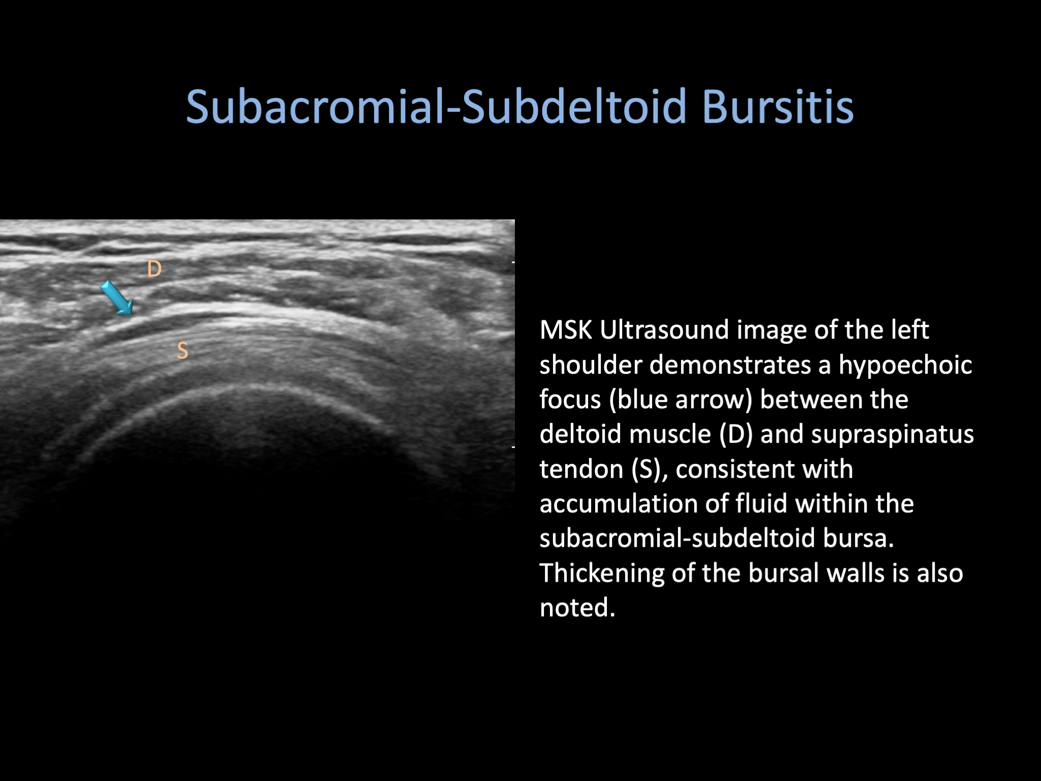 subdeltoid bursitis