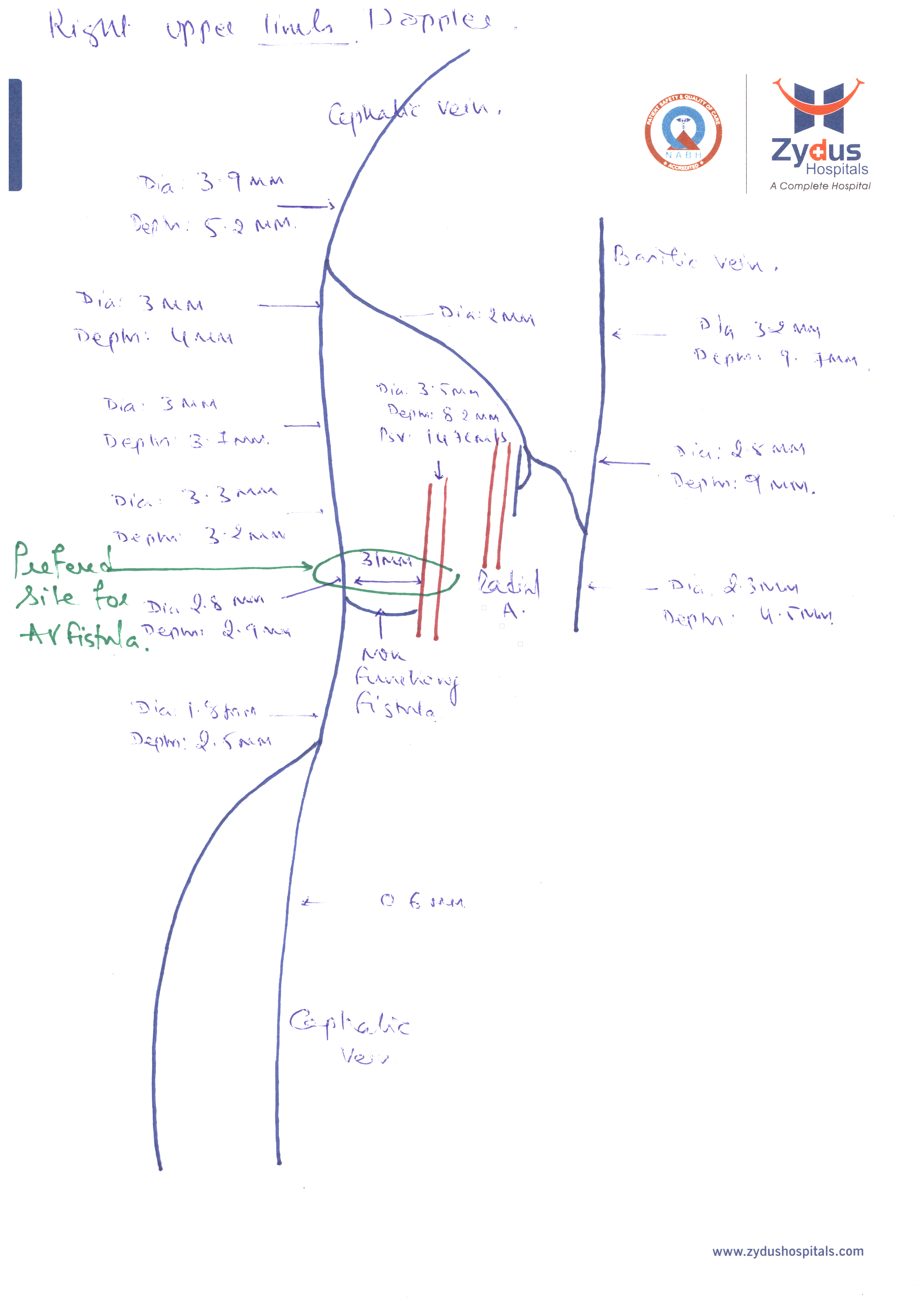 Doppler vascular mapping in Arterio Venous Fistula (AVF)