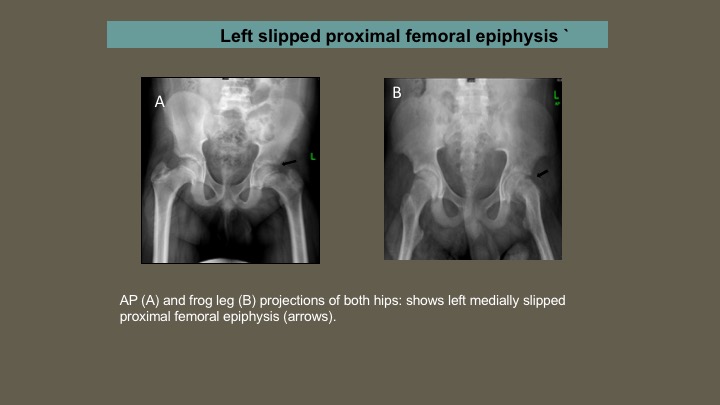 slipped capital femoral epiphysis vs legg calve perthes disease