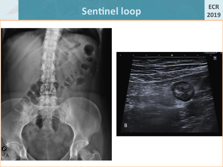 sentinel loop appendicitis