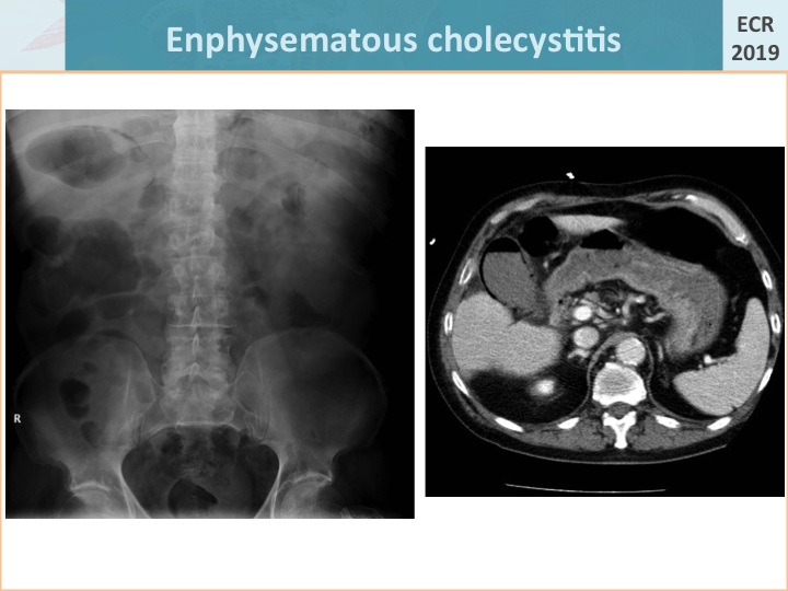 cholecystitis x ray