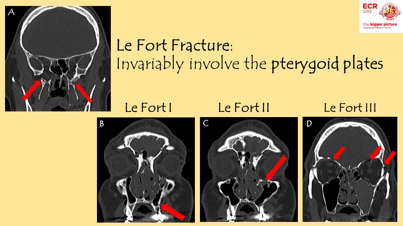 le fort fracture x ray