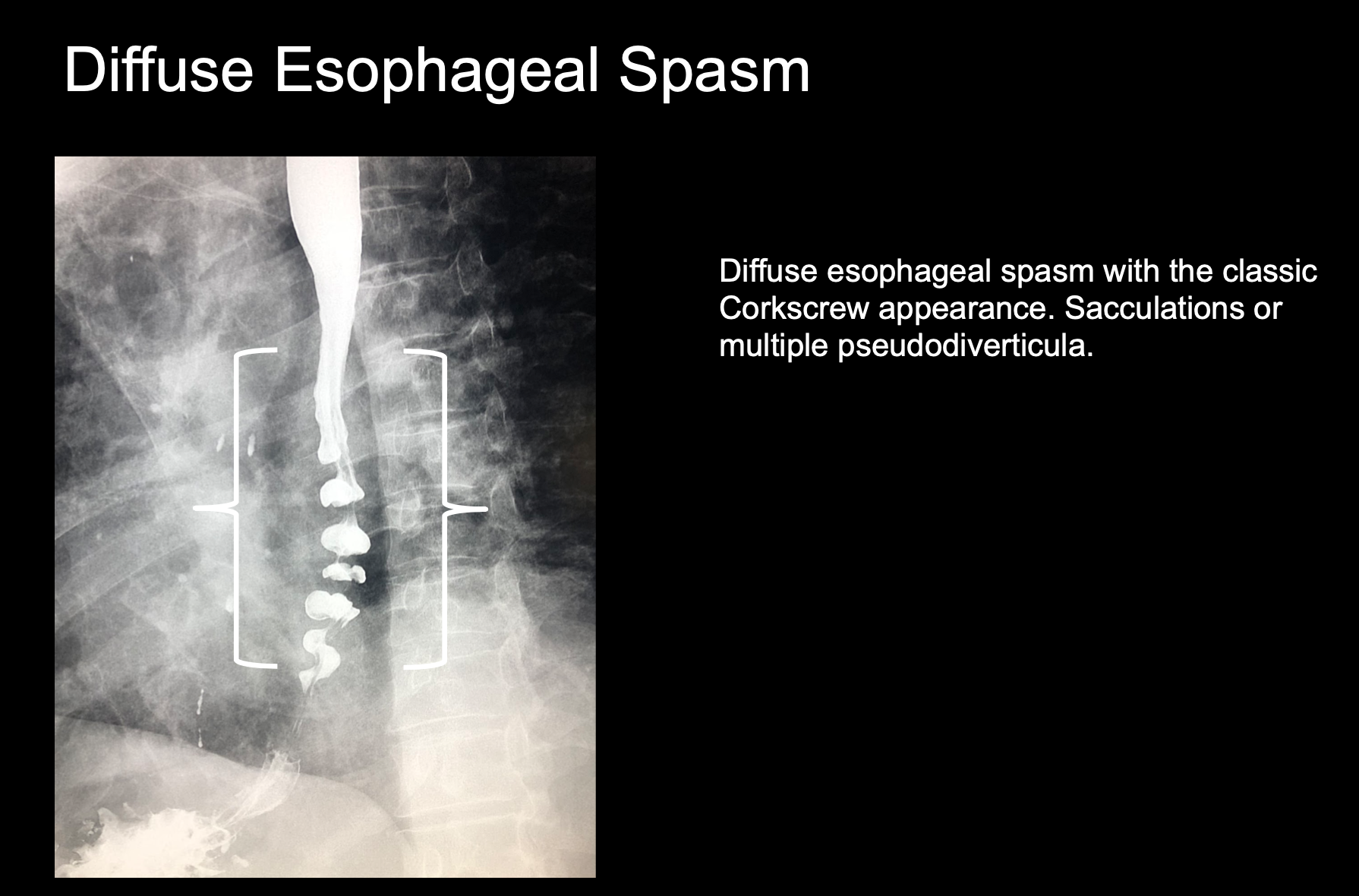 esophageal web barium swallow