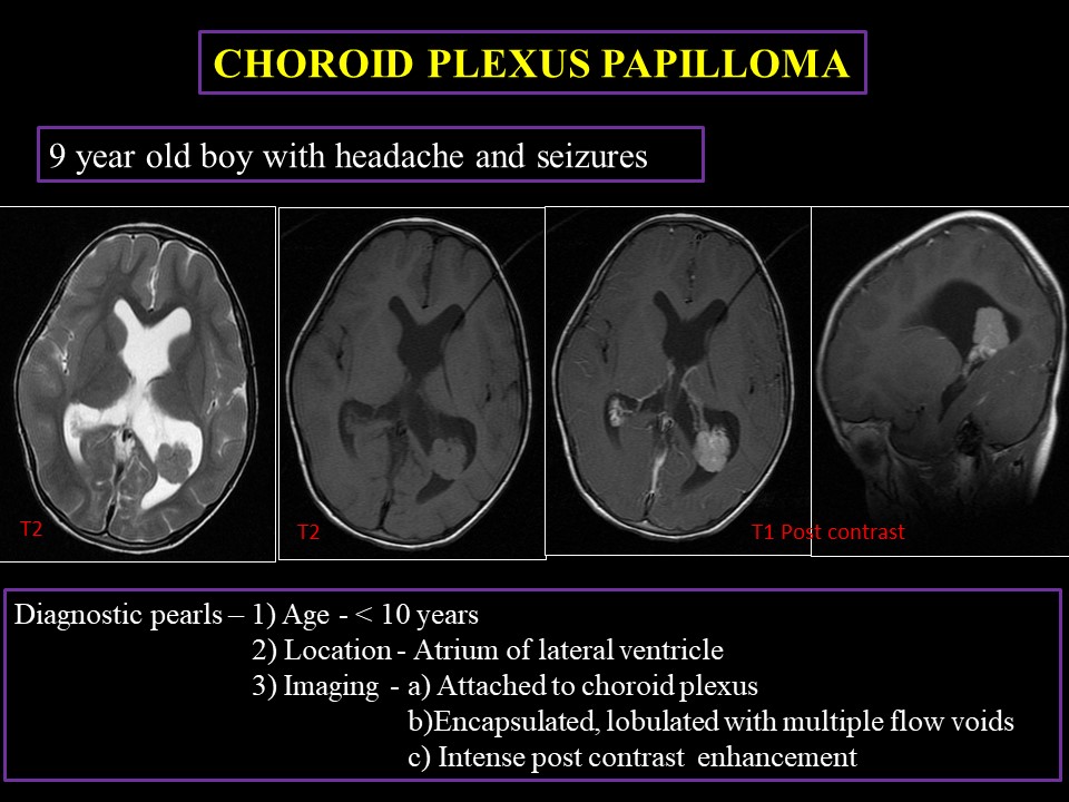 Choroid Plexus Papilloma of the Fourth Ventricle: A Pediatric Patient - Choroid plexus papilloma