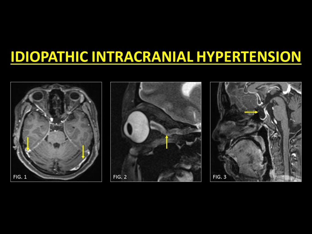 idiopathic intracranial hypertension mri