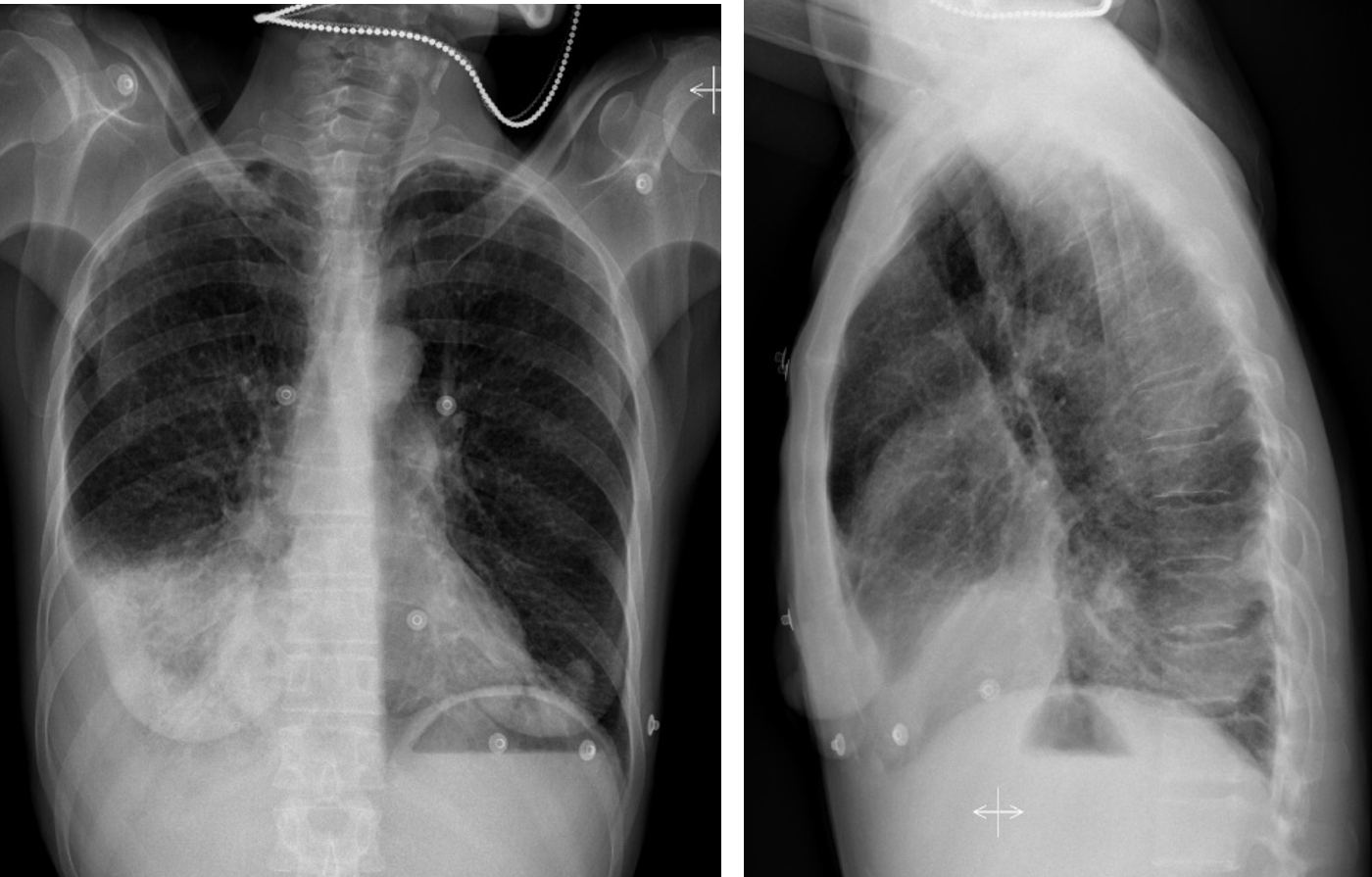 chest x ray pleural effusion