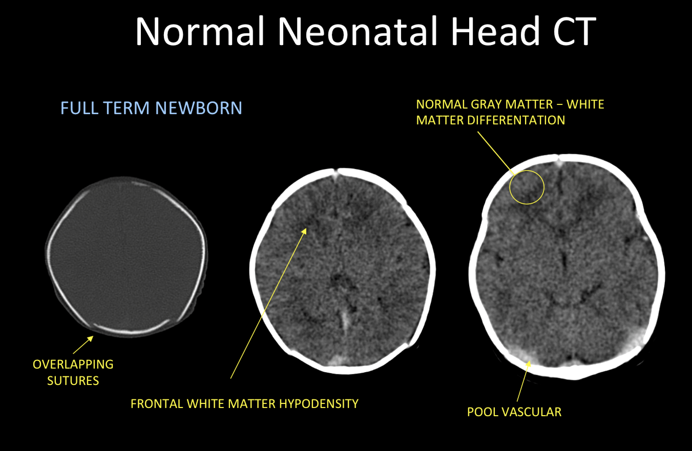 Normal Ct Brain