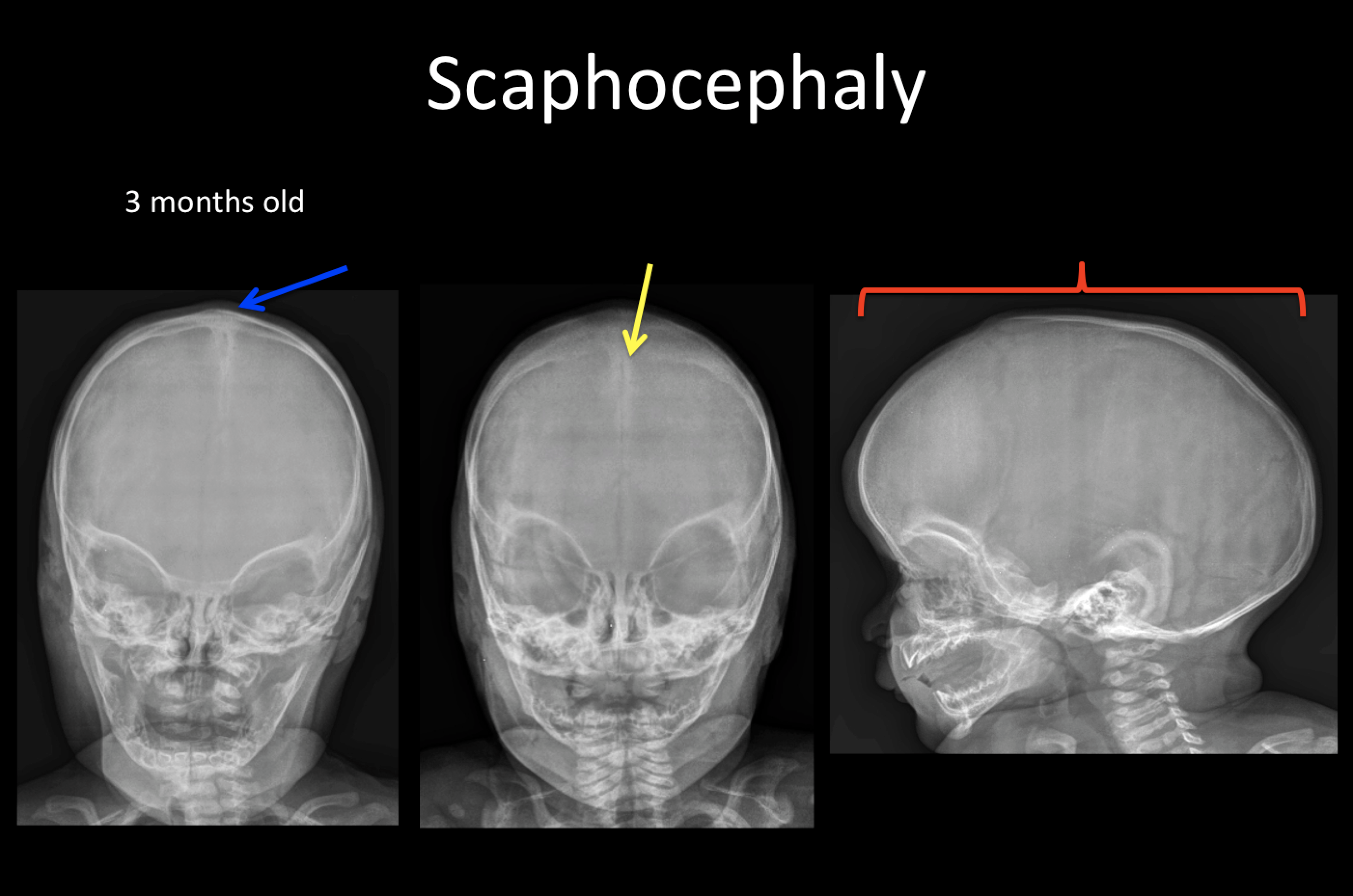 scaphocephaly