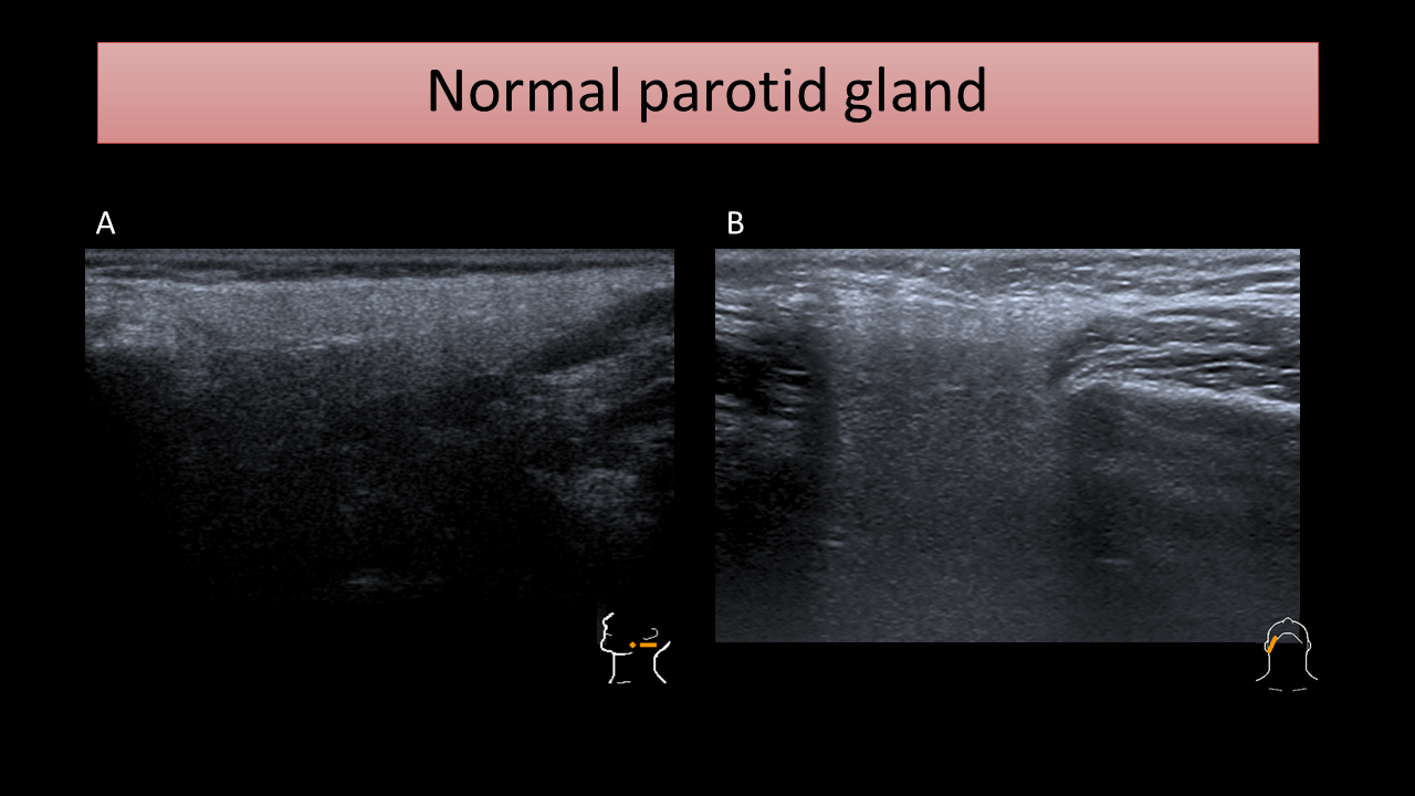 Parotid Abscess Ultrasound