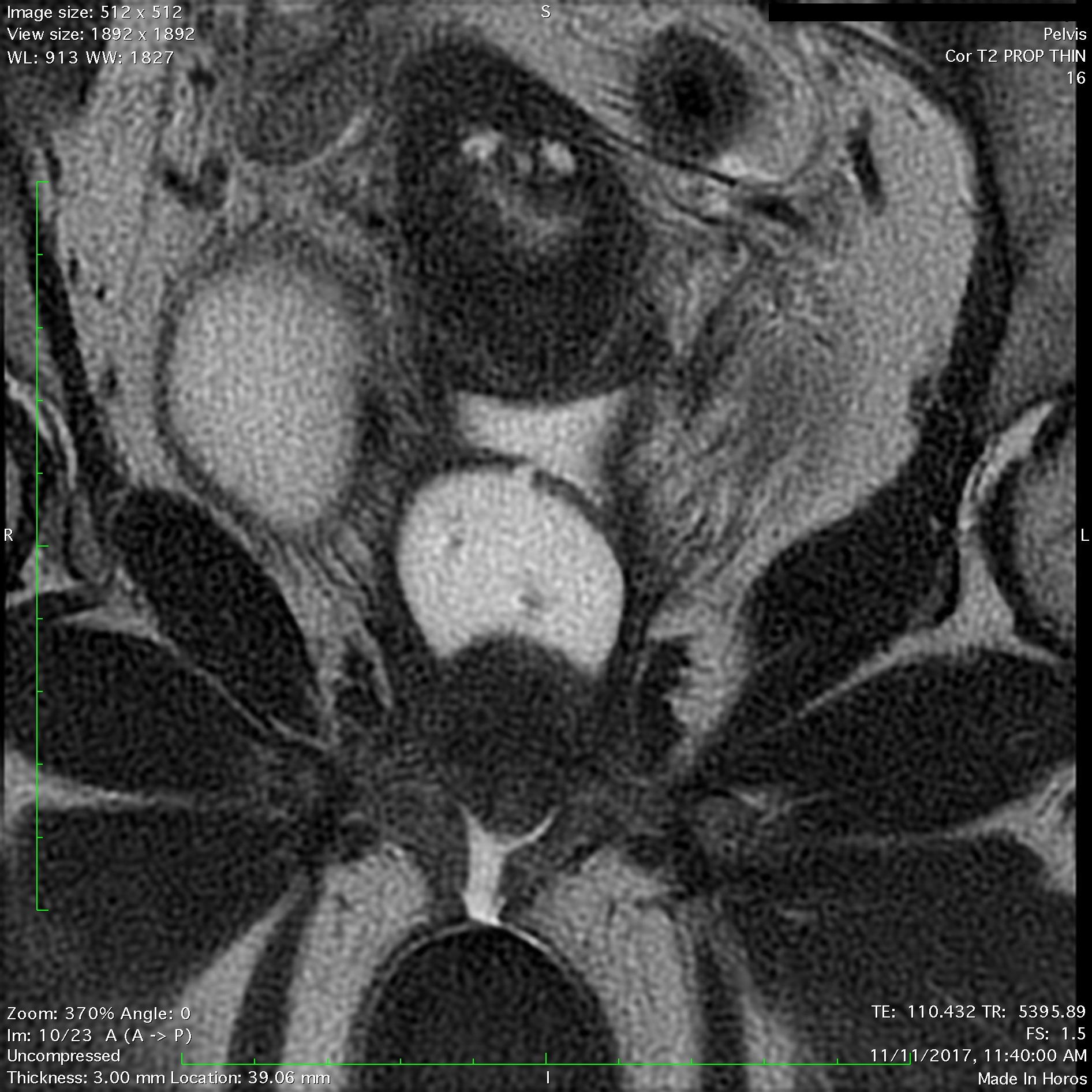 RMN Prostata Multiparametric