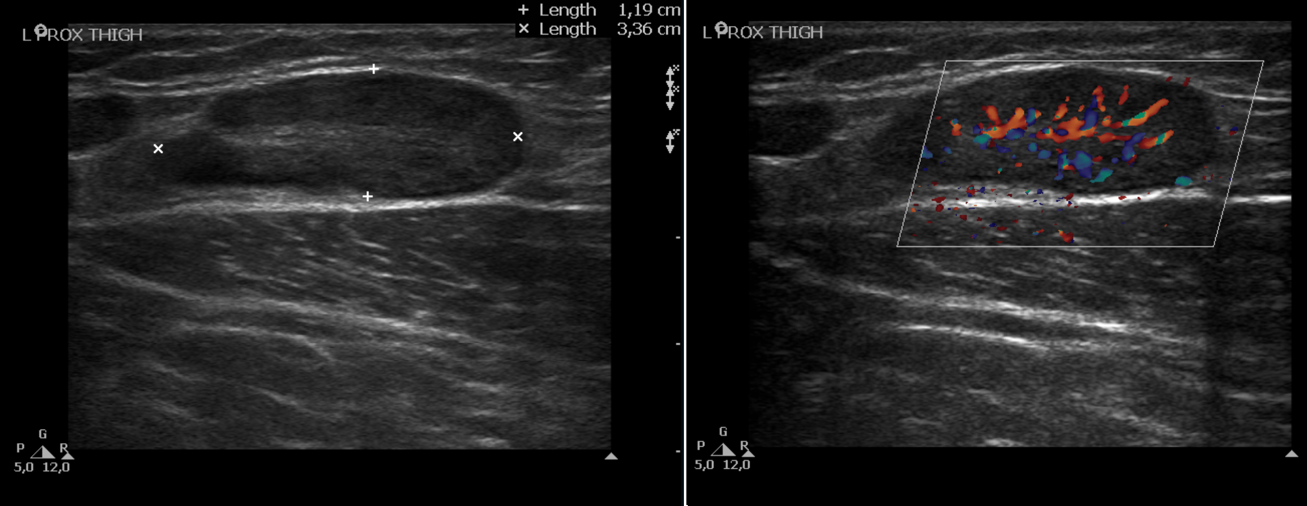 groin lymph nodes ultrasound